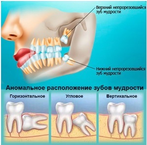 Сложно ли расставаться с зубами мудрости