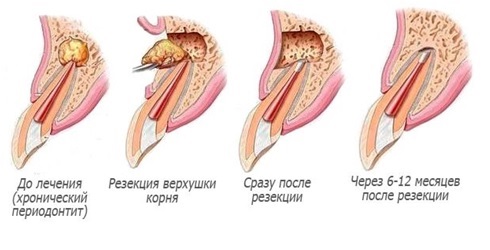 Операция резекции верхушки корня