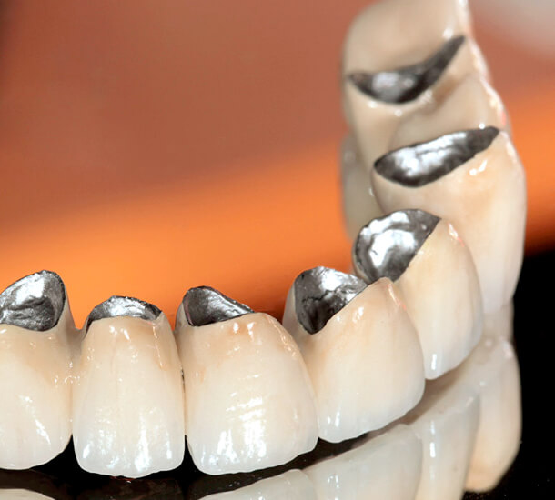 Что важно знать пациентам перед установкой зубного моста?
